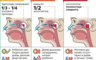 Масло туи при аденоидах: отзывы, инструкция применения, как помогает